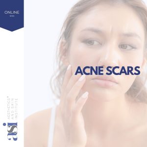 Acne Scars